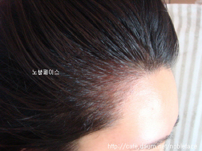 일산 노블페이스 헤어쉐딩 시술후기~~!