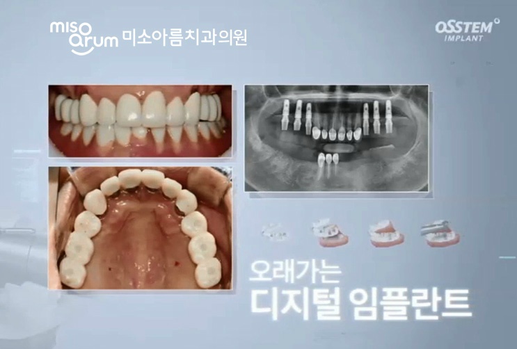 전주임플란트치과 빠진 치아를 방치할 경우 나타나는 문제점