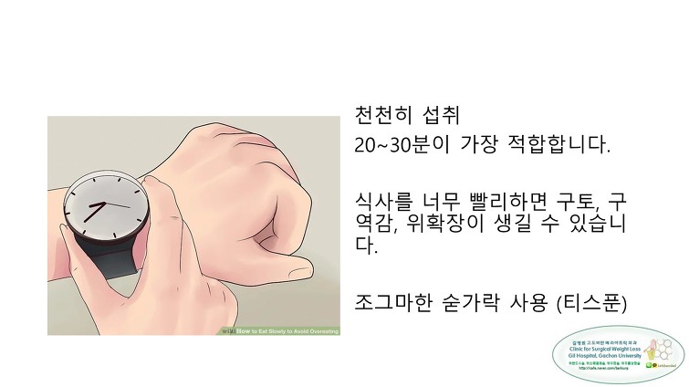 고도비만수술의 대세 위소매절제술 후 일반식하기